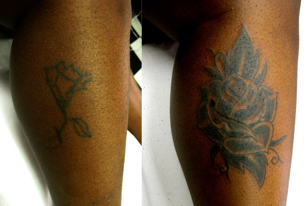 Other Methods Of Tattoo Removal