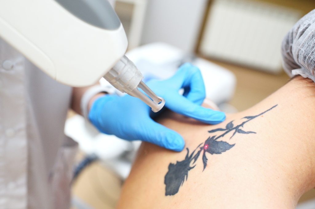Laser tattoo removal process