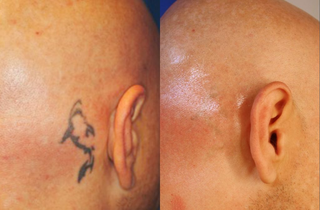 Skin discoloration on laser treated area