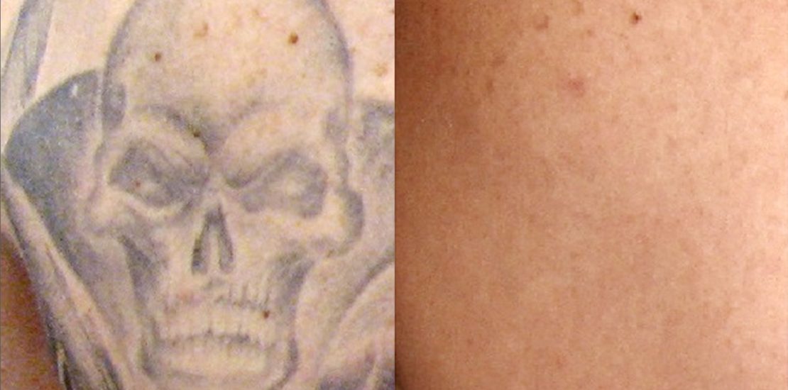 Tattoo removal before and after  - Fading Regrets