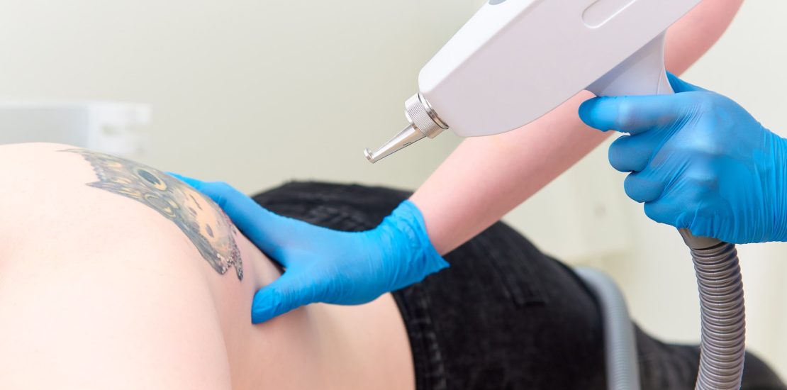 A person getting a laser on skin for tattoo removal purposes